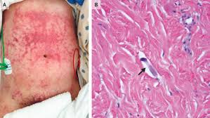 Strongyloides stercoralis - Larva currens